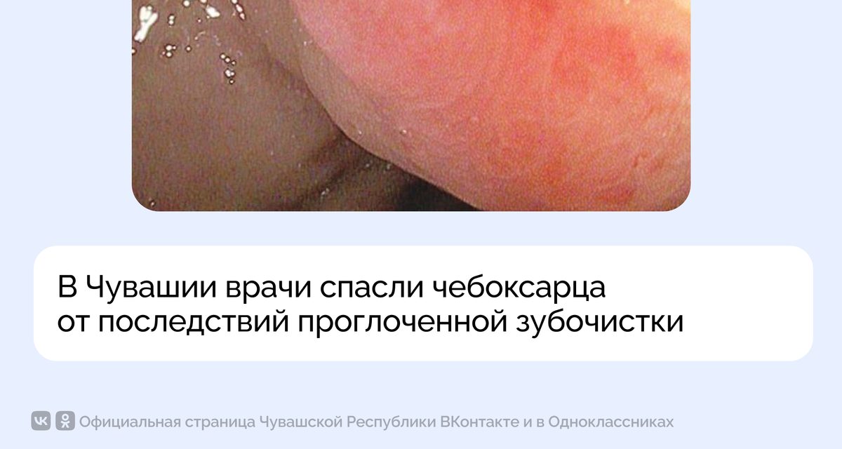 Зубочистка проткнула кишку 30-летнего чебоксарца, но хирурги обошлись без открытой операции